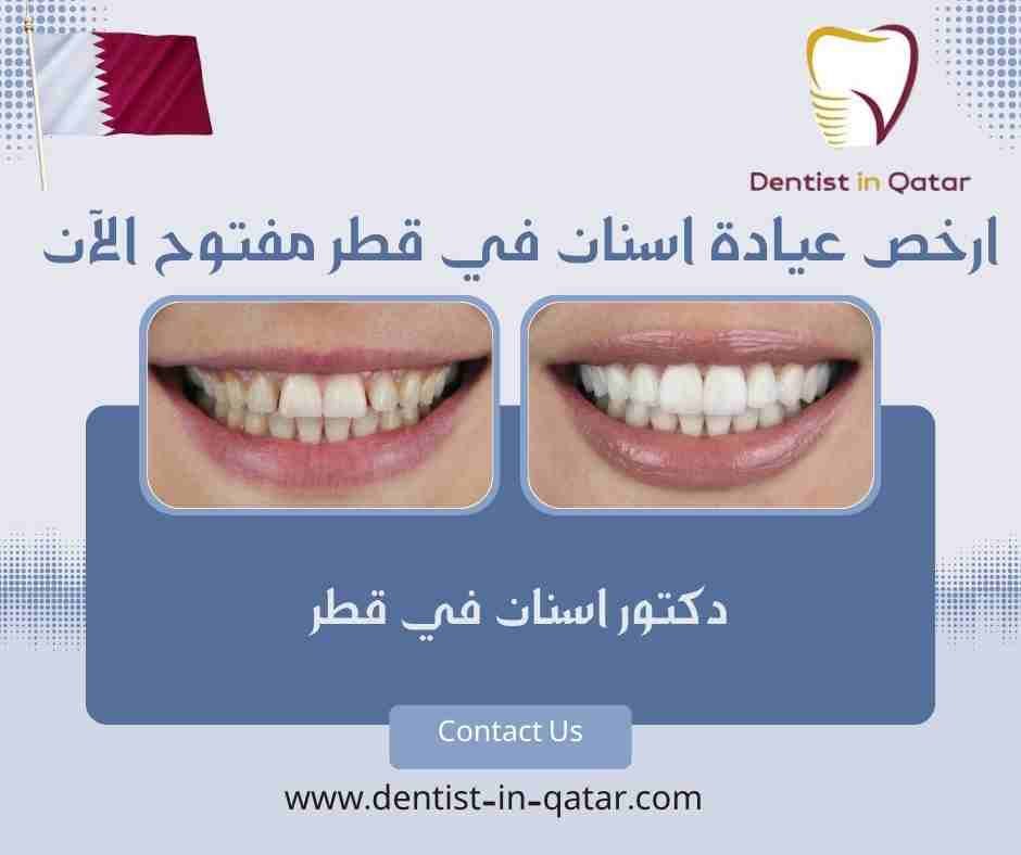 ارخص عيادة اسنان في قطر مفتوح الآن