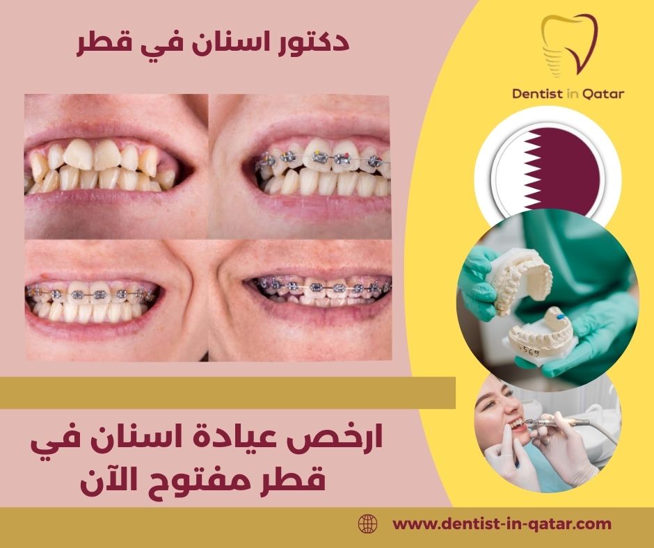 عروض عيادات الأسنان قطر