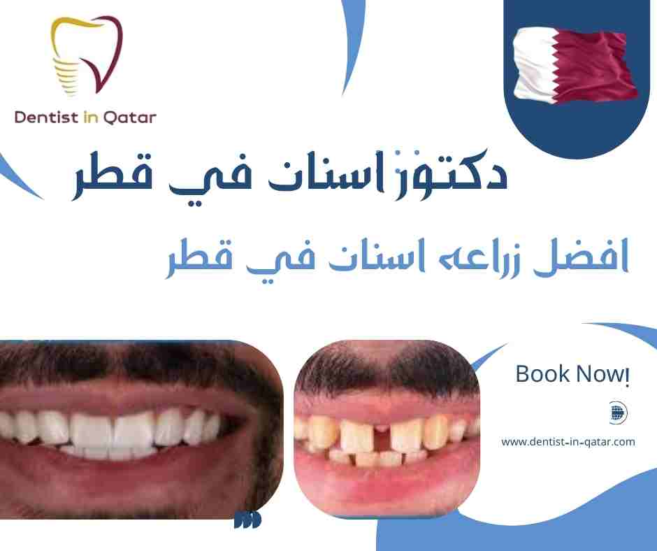 افضل زراعه اسنان في قطر