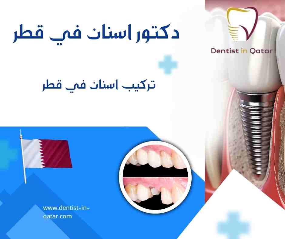 تركيب اسنان في قطر