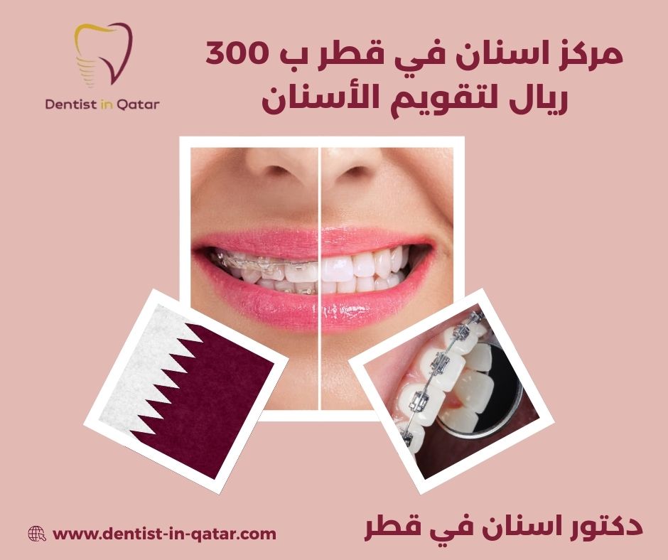 مركز اسنان في قطر ب 300 ريال لتقويم الأسنان