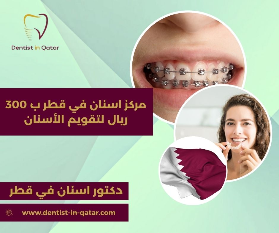 مركز اسنان في قطر ب 300 ريال لتقويم الاسنان