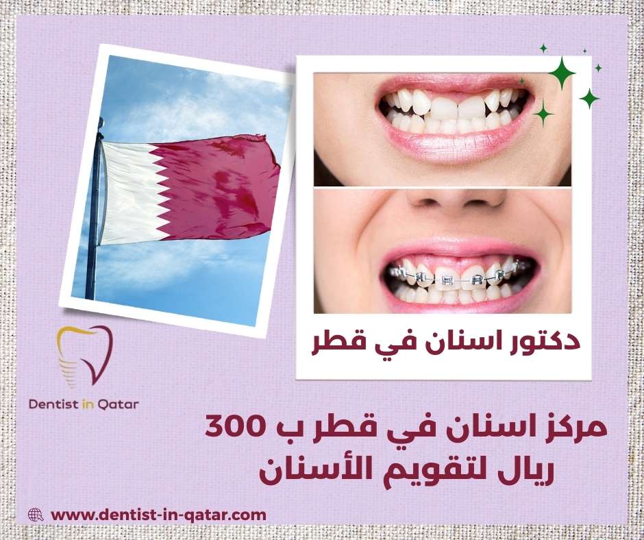 مركز اسنان في قطر ب 300 ريال لتقويم الأسنان