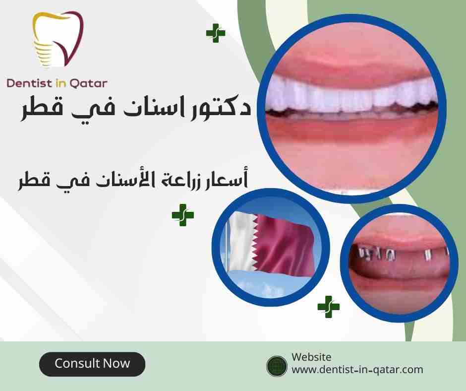 أسعار زراعة الأسنان في قطر