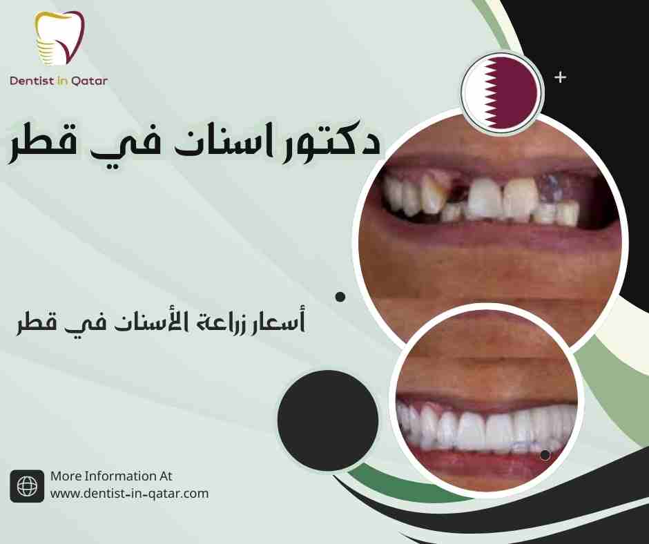 أسعار زراعة الأسنان في قطر