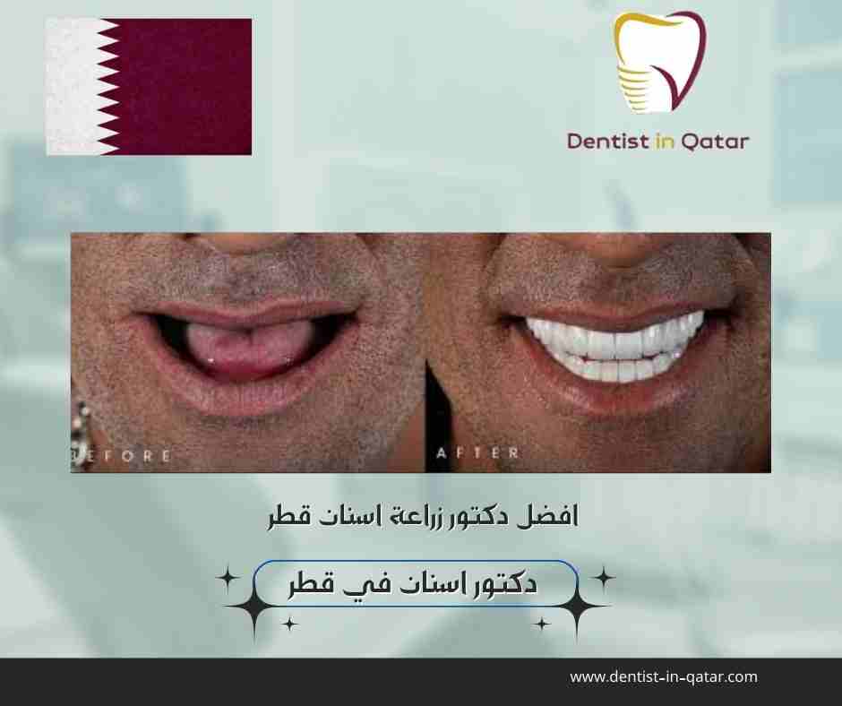 افضل دكتور زراعة اسنان قطر