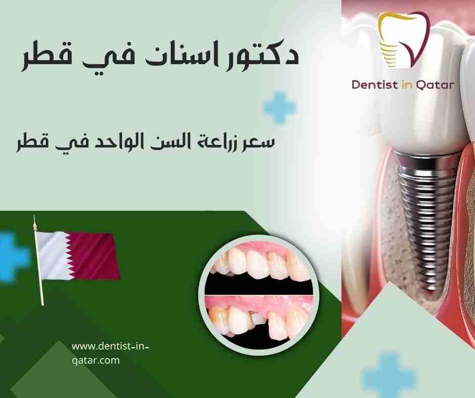 سعر زراعة السن الواحد في قطر