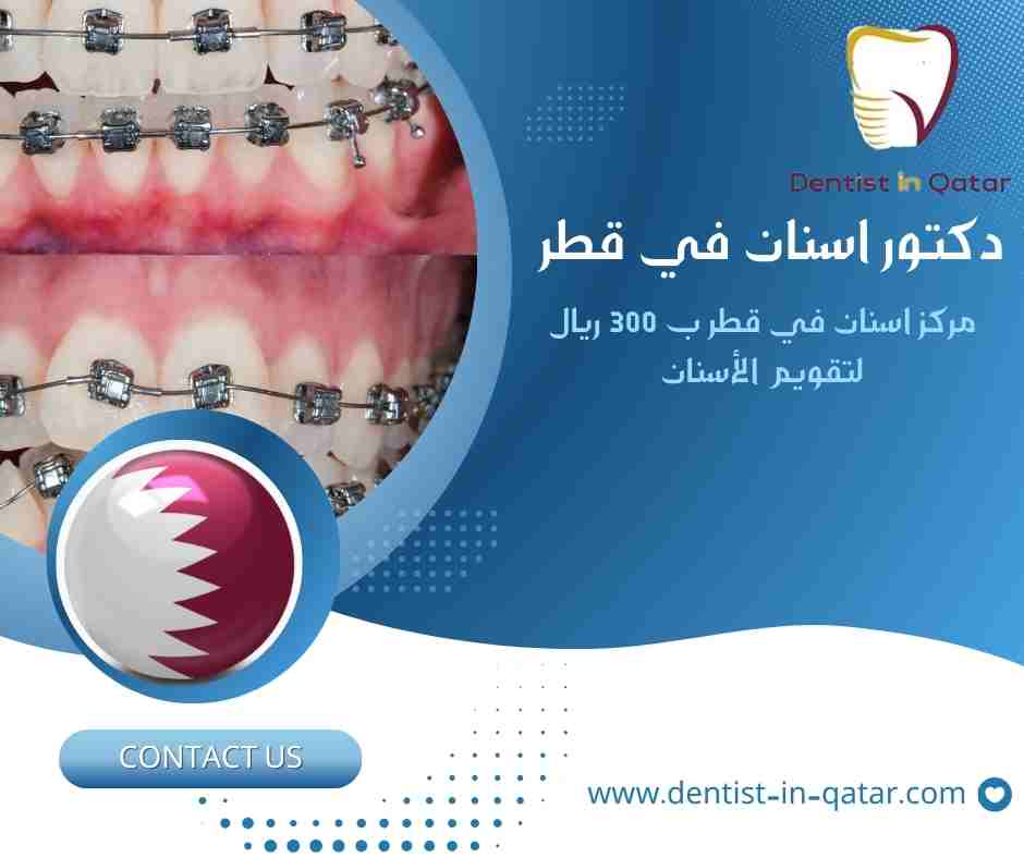 مركز اسنان في قطر ب 300 ريال لتقويم الأسنان