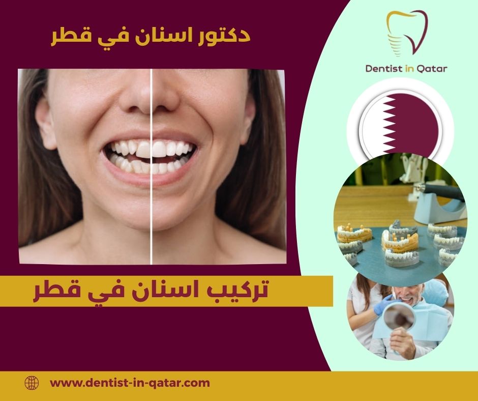 افضل دكتور تركيب اسنان في قطر
