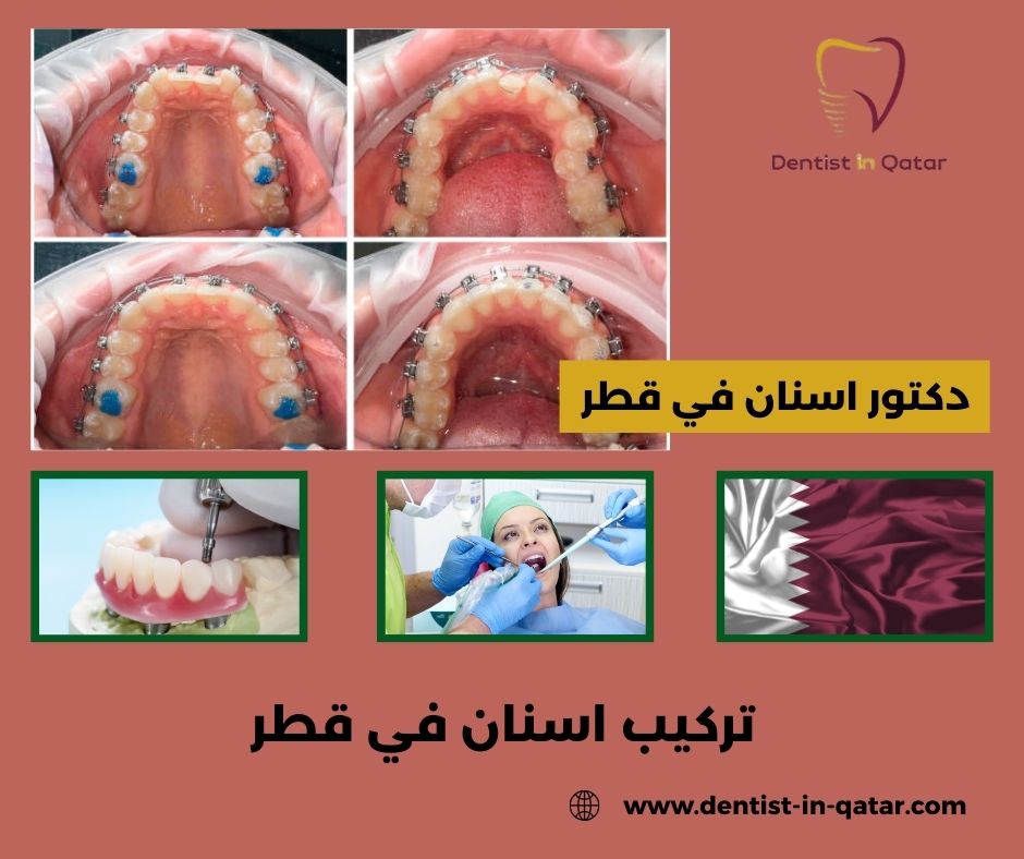 تركيب اسنان في قطر