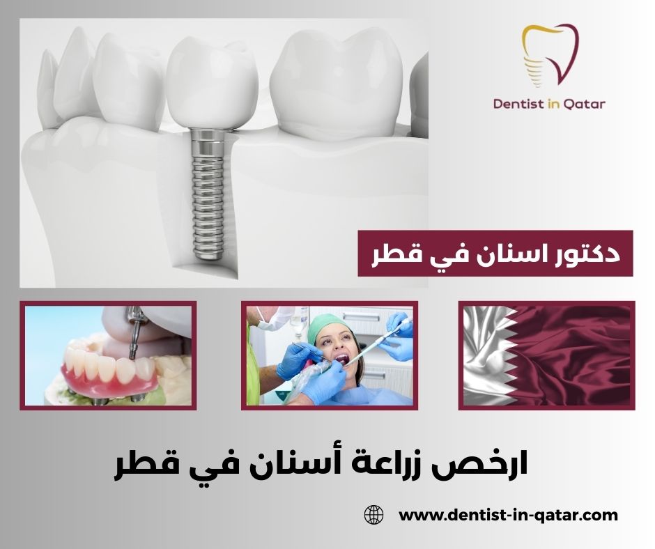 اسعار زراعة الاسنان في قطر