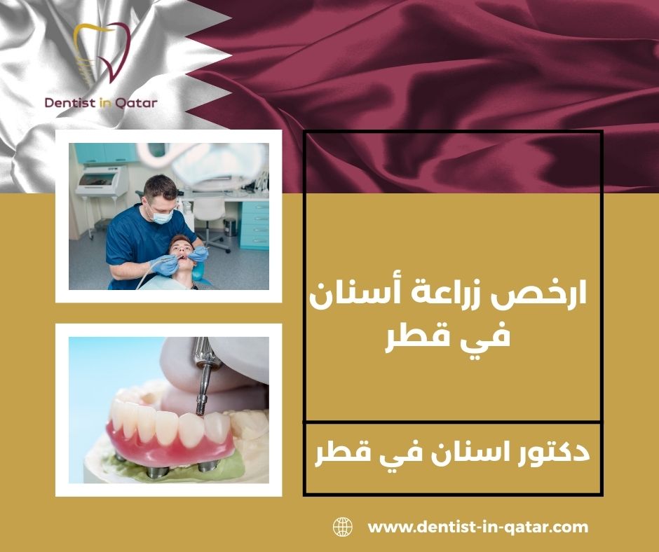  ارخص زراعة أسنان في قطر