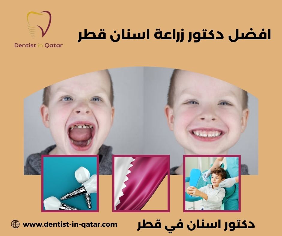 أفضل دكتور زراعة أسنان في قطر