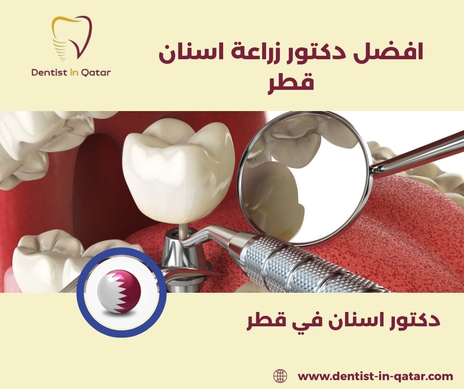 افضل دكتور زراعة اسنان قطر
