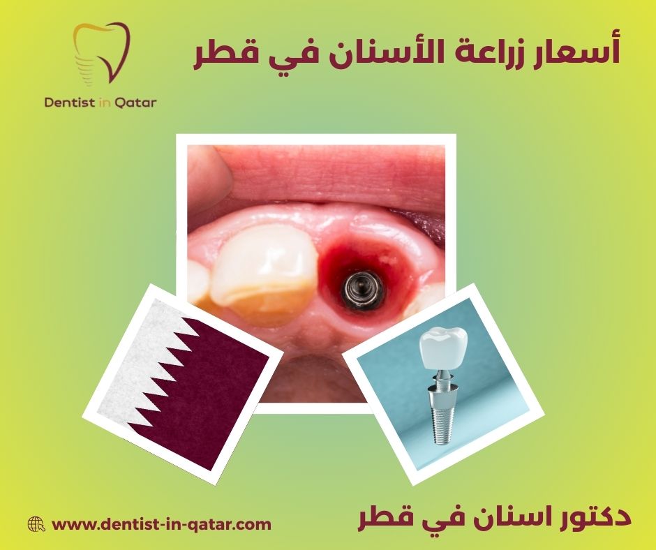 زراعة الأسنان قطر