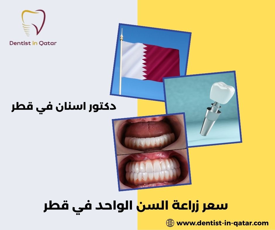 تكلفة زراعة الاسنان في قطر