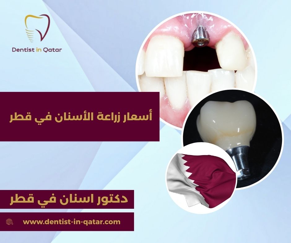 سعر زراعة الاسنان في قطر