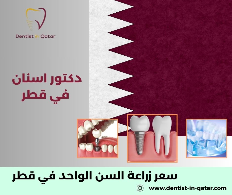 سعر زراعة السن الواحد في قطر