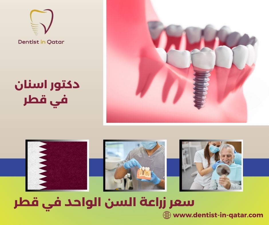 سعر زراعة السن الواحد في قطر