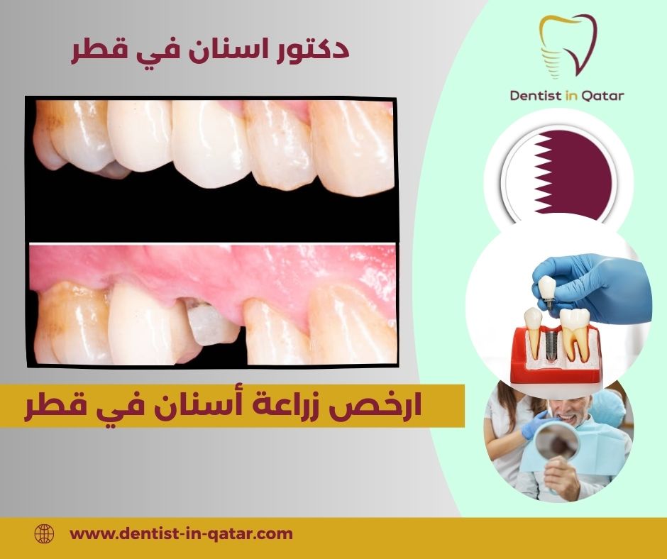 زراعة اسنان في قطر