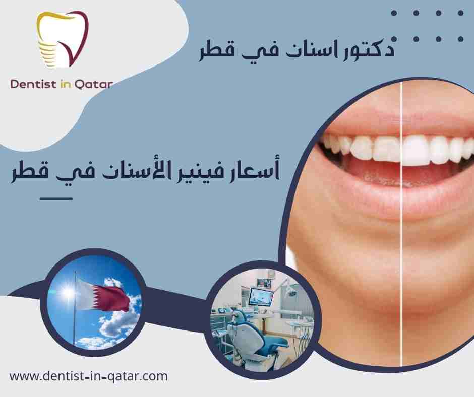 أسعار فينير الأسنان في قطر