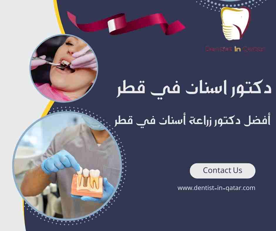 أفضل دكتور زراعة أسنان في قطر
