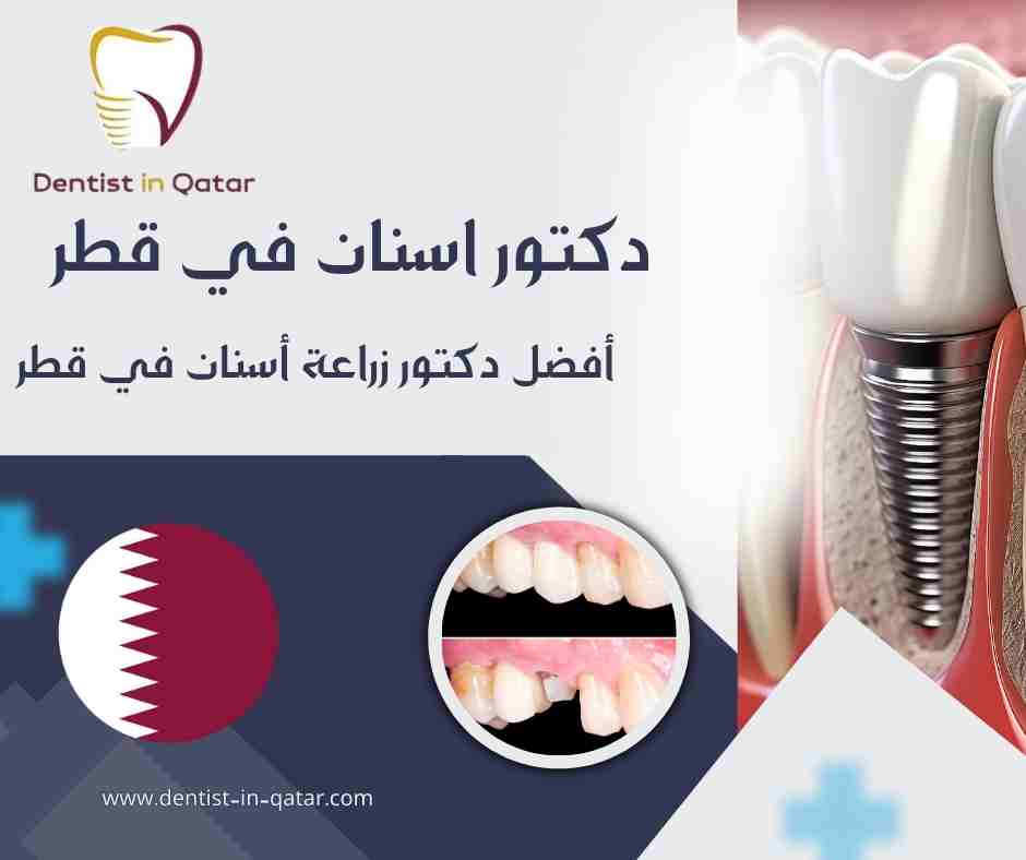أفضل دكتور زراعة أسنان في قطر