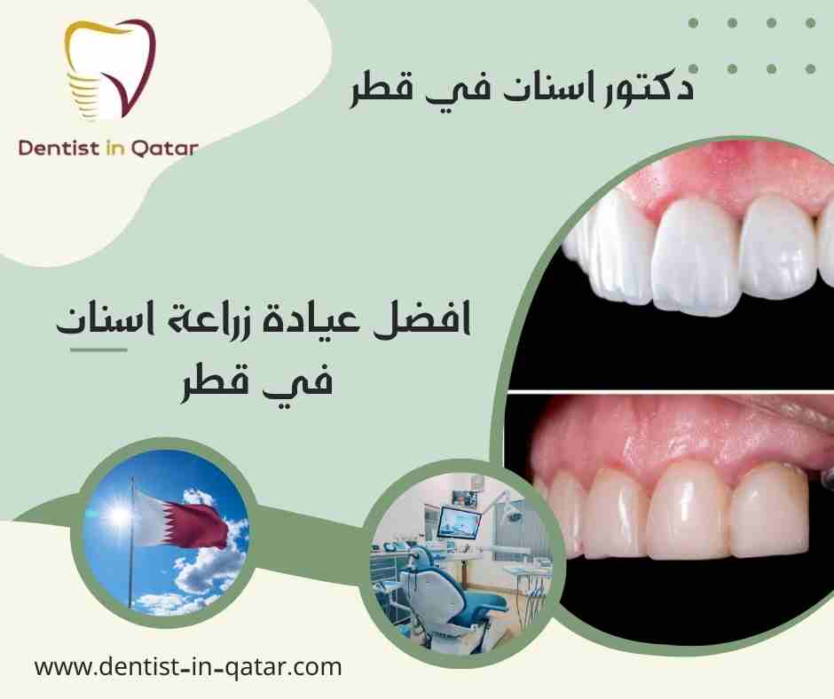 افضل عيادة زراعة اسنان في قطر