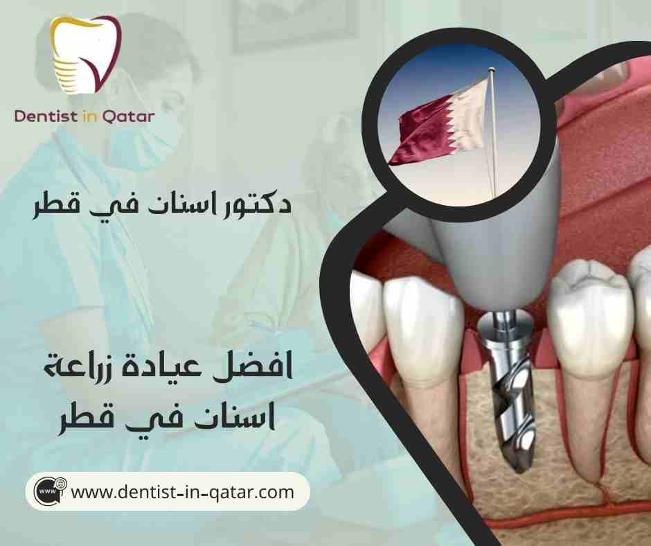 افضل عيادة زراعة اسنان في قطر