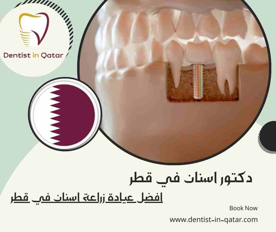 افضل عيادة زراعة اسنان في قطر