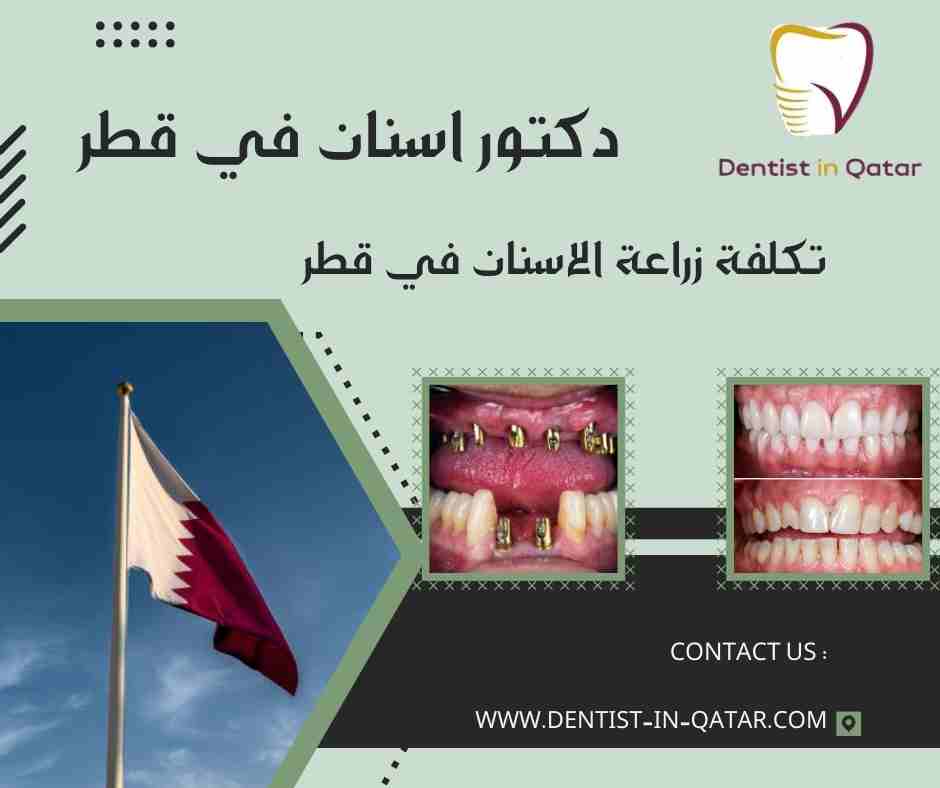 تكلفة زراعة الاسنان في قطر