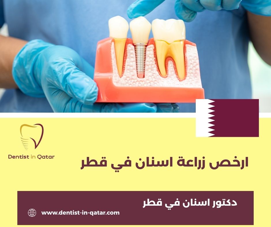 اسعار زراعه الاسنان في قطر