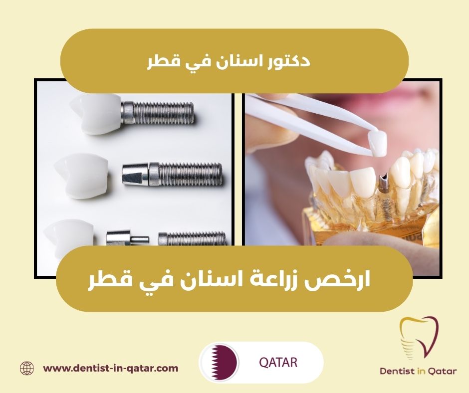 اسعار زراعة الاسنان في قطر