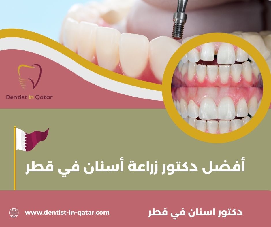 افضل دكتور زراعة اسنان في قطر