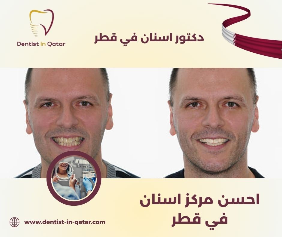 احسن مركز اسنان في قطر