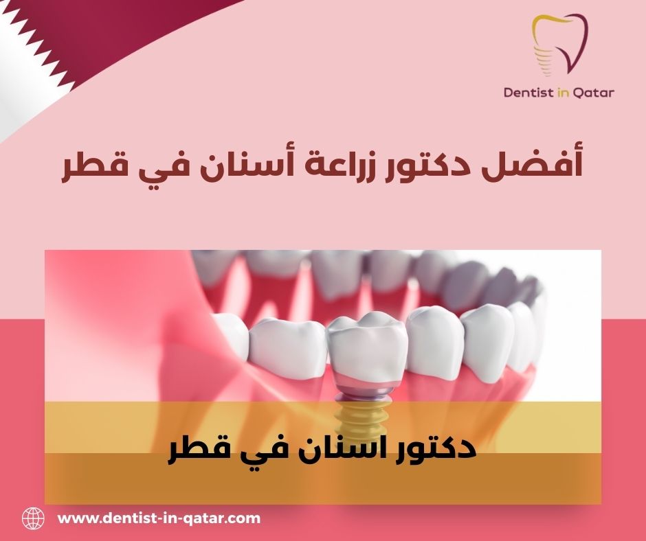 افضل دكتور زراعة اسنان في قطر
