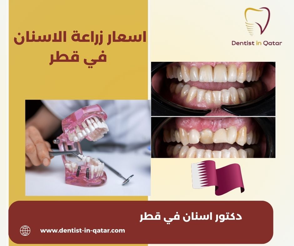اسعار زراعة الاسنان في قطر