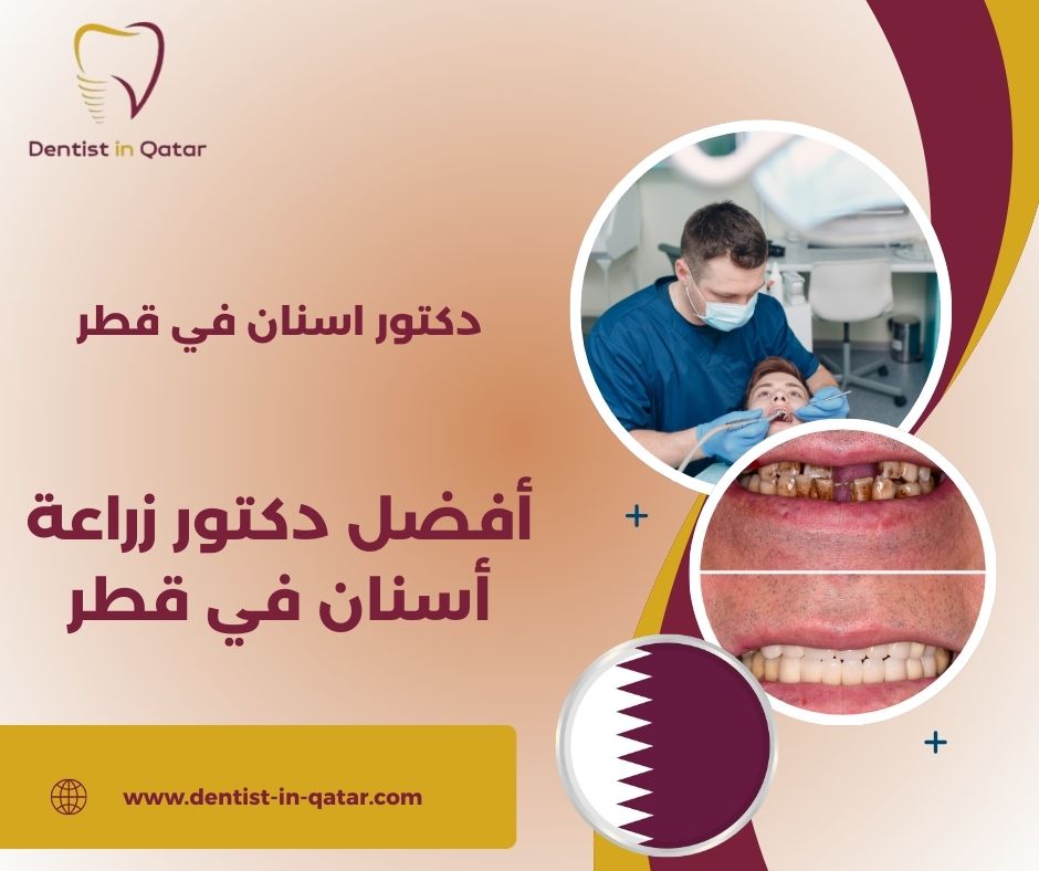 أفضل دكتور زراعة أسنان في قطر