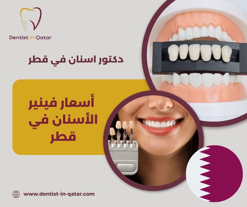 أسعار فينير الأسنان في قطر