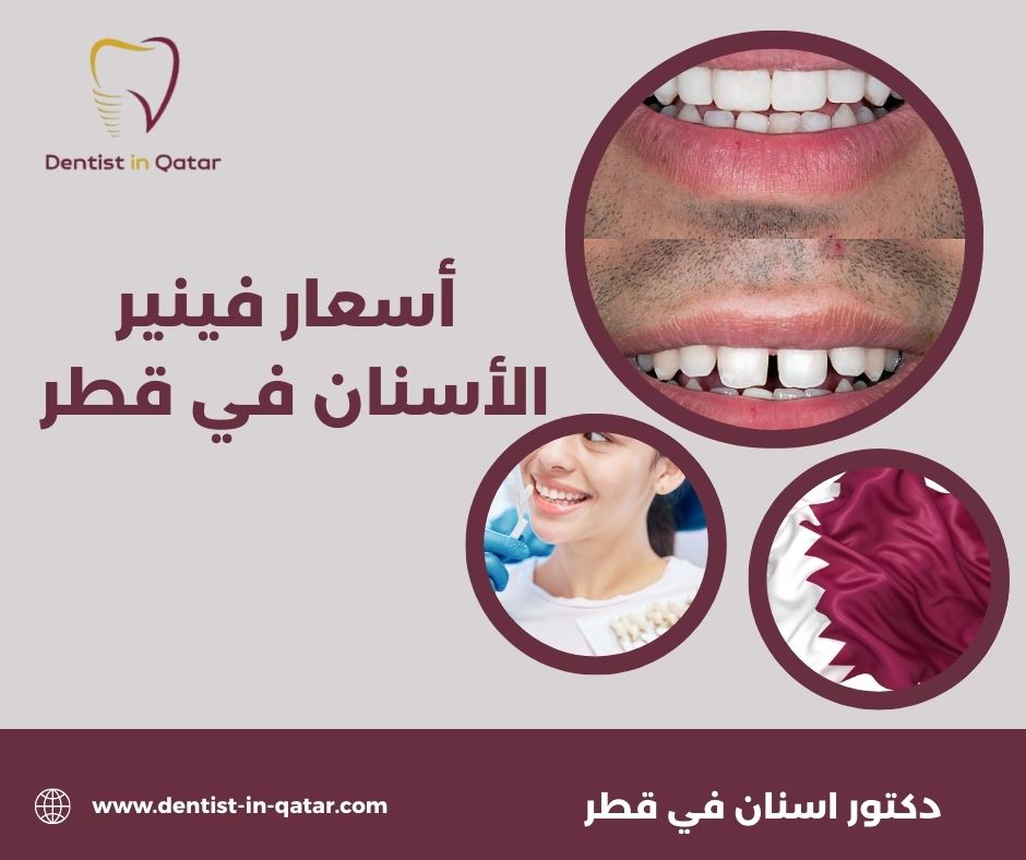 أسعار فينير الأسنان في قطر
