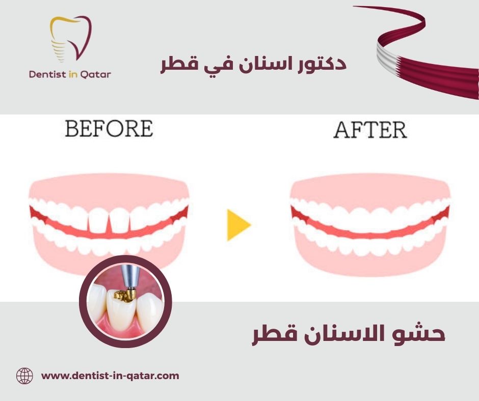 حشو الاسنان قطر