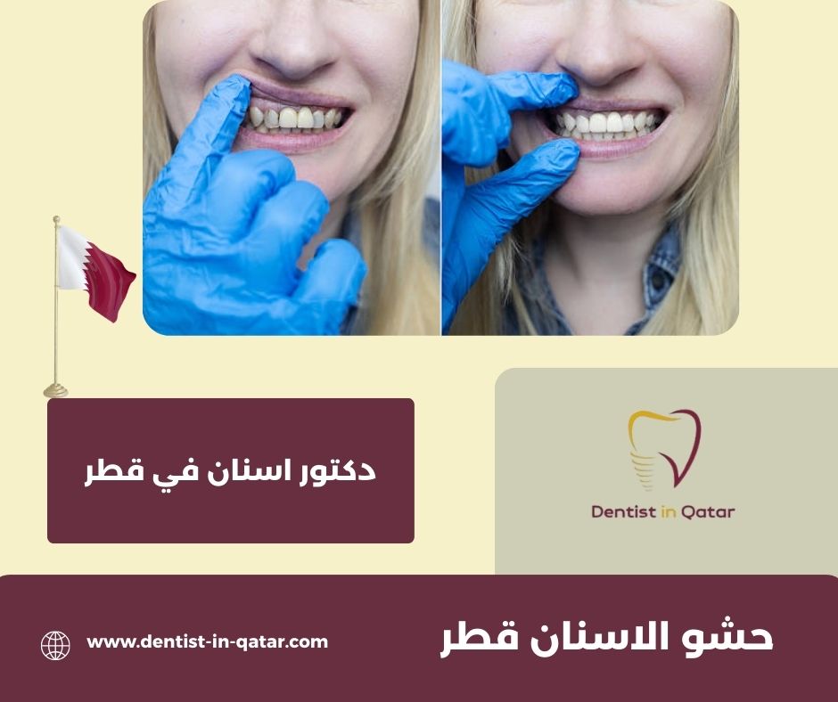 زراعة الاسنان قطر