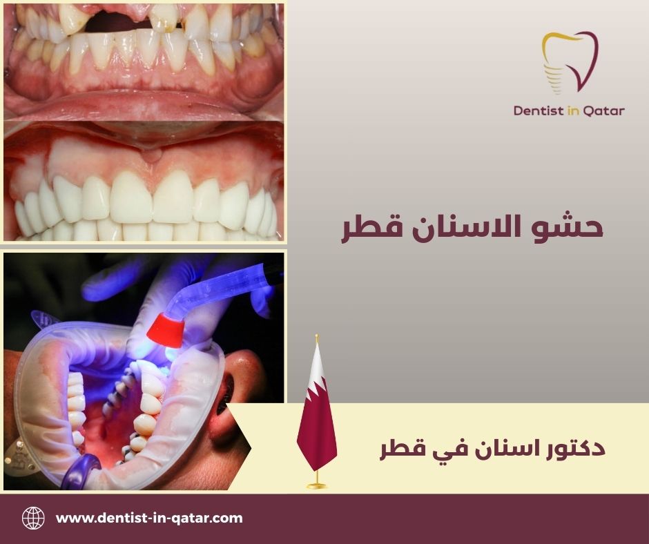 حشو الاسنان قطر