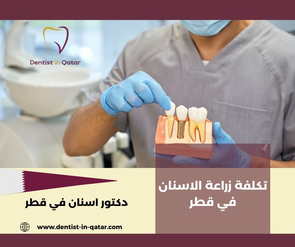 تكلفة زراعة الاسنان في قطر