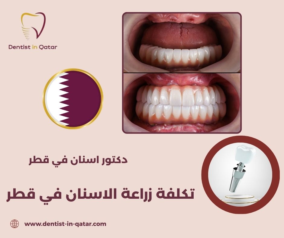 كم تكلفة زراعة الاسنان في قطر