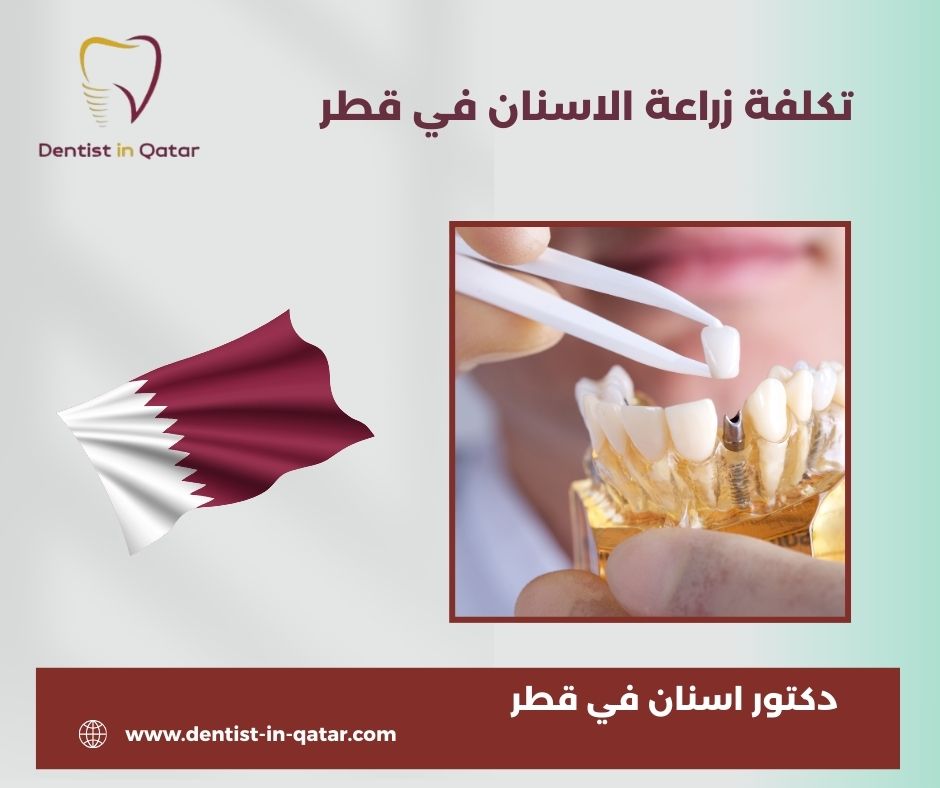 أسعار زراعة الأسنان في قطر