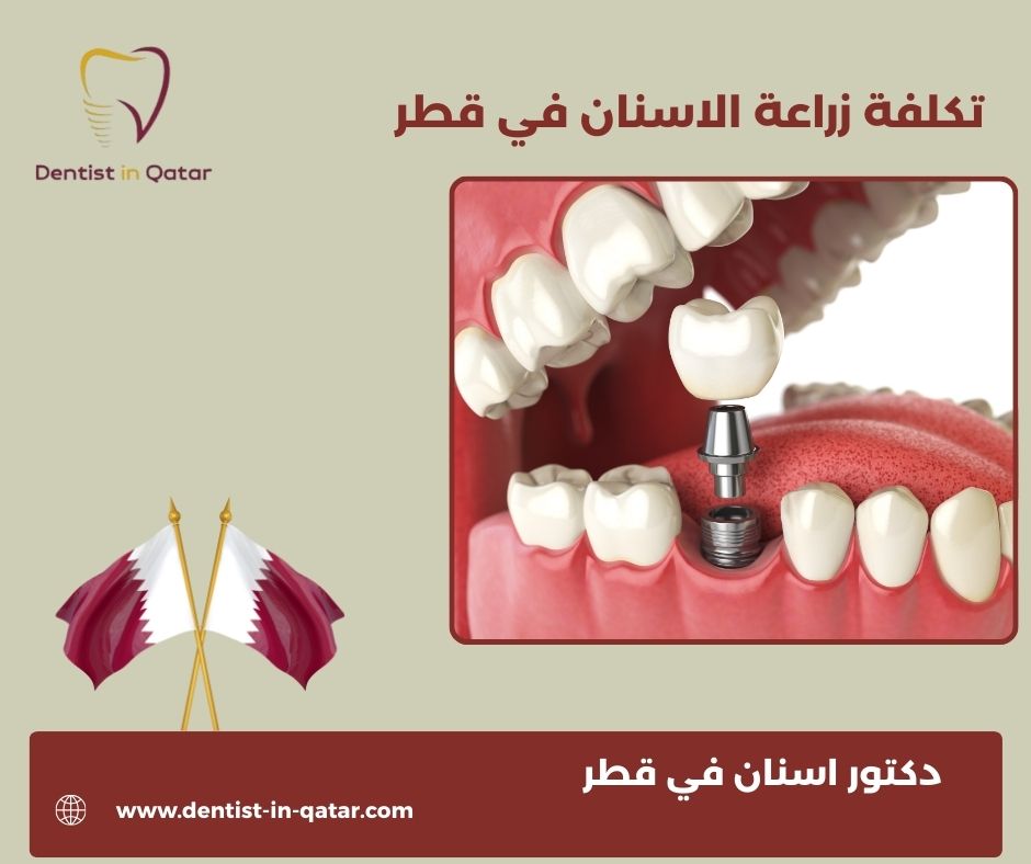 سعر زراعة الاسنان في قطر
