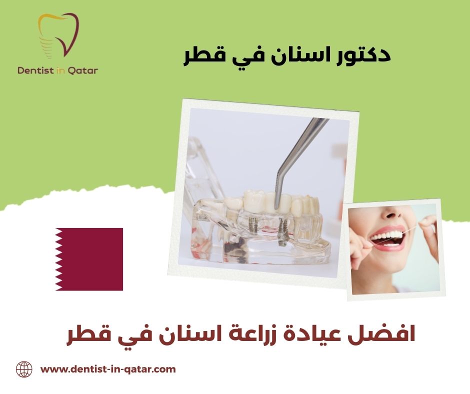 افضل عيادة زراعة اسنان في قطر