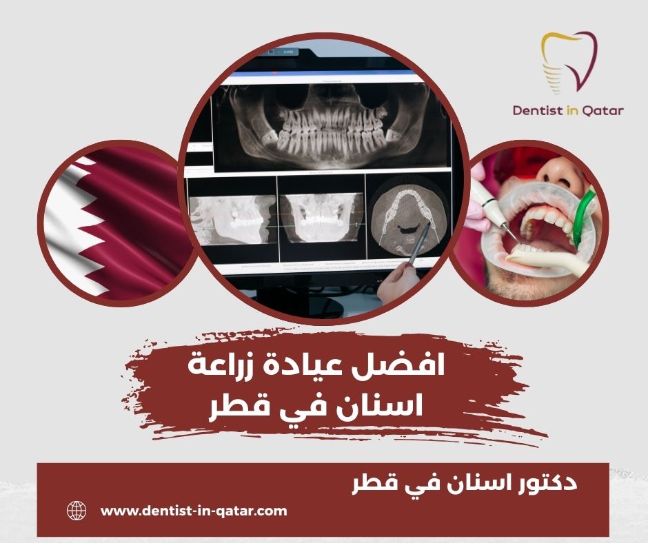 افضل عيادة زراعة اسنان في الدوحة