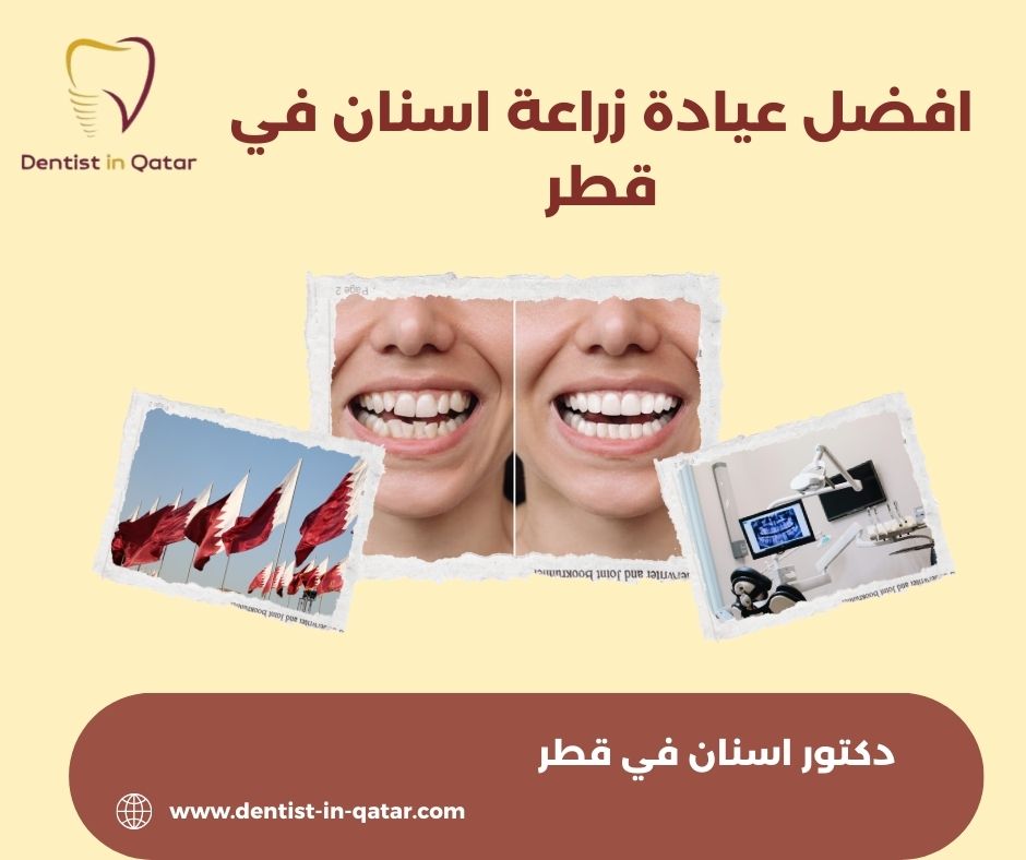افضل عيادة زراعة اسنان في قطر